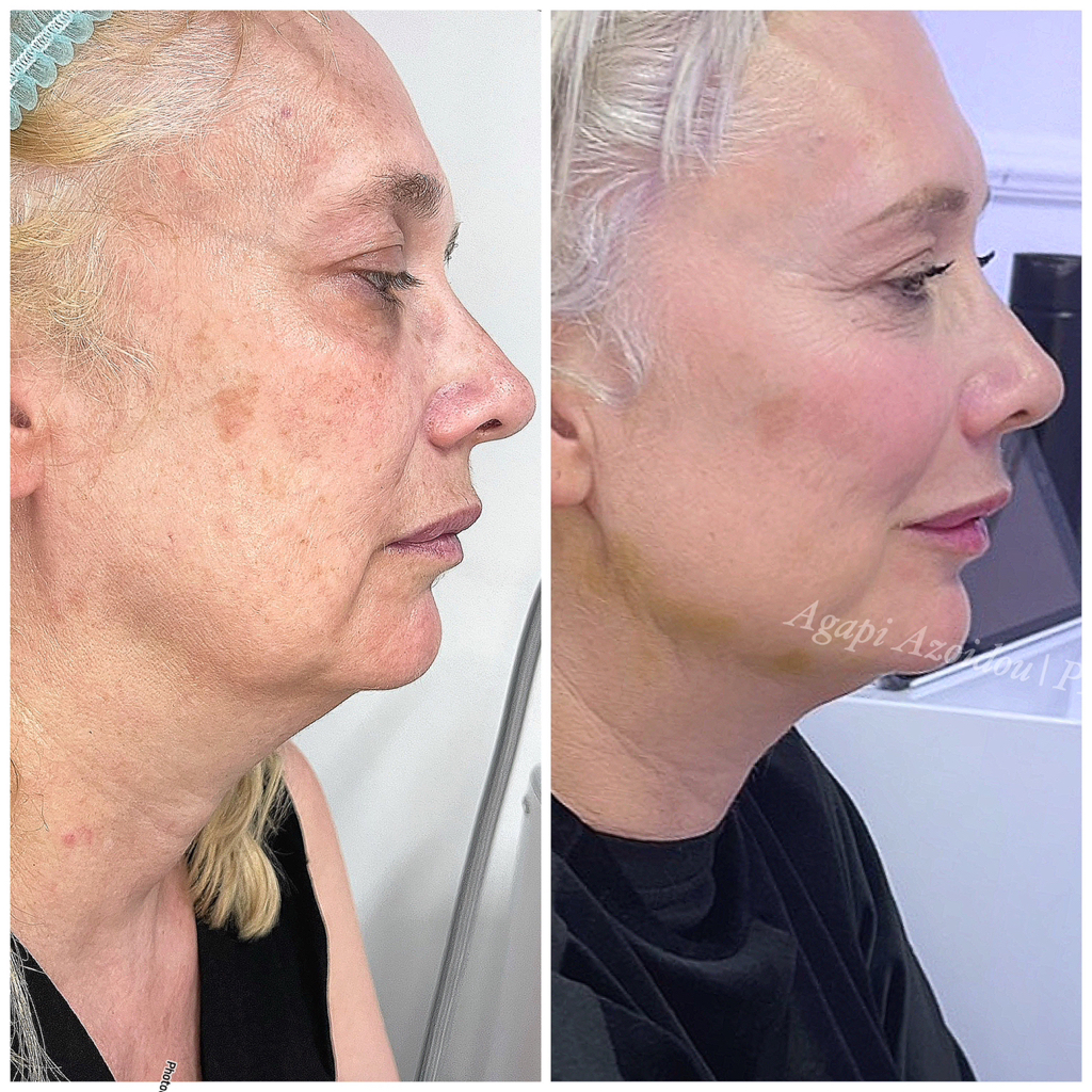 BEAUTIFICATION FACE & BODY : MARILYN -MONROE  FACE&BODY  Διόρθωση ατέλειες (5 θεραπείες Ανόρθωση, λίφτινγκ)