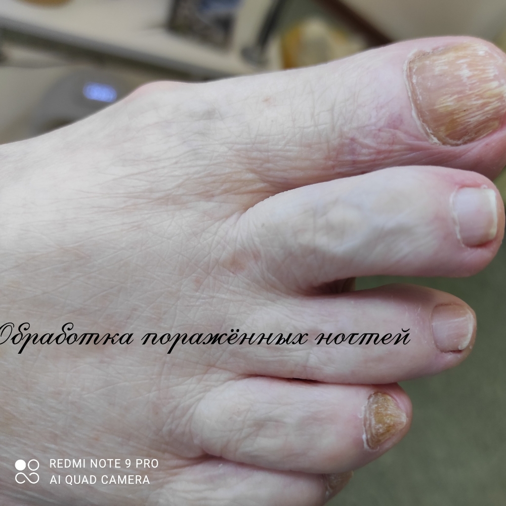 Медицинская обработка поражённых ногтей и стоп