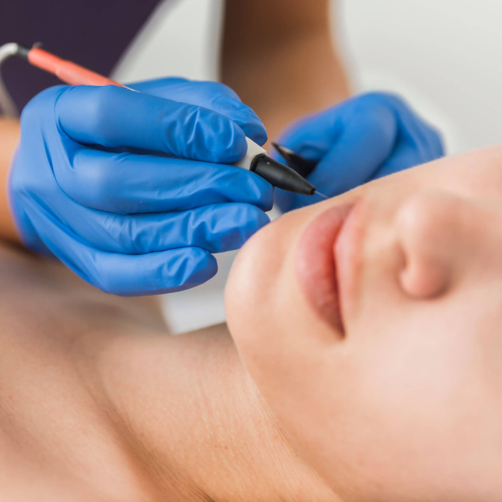 Электроэпиляция - Лицо