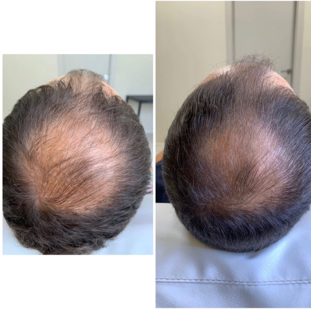 Мезотерапия кожи головы