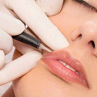 Электроэпиляция - Пушковые волоски