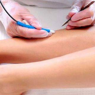 Электроэпиляция - Тело