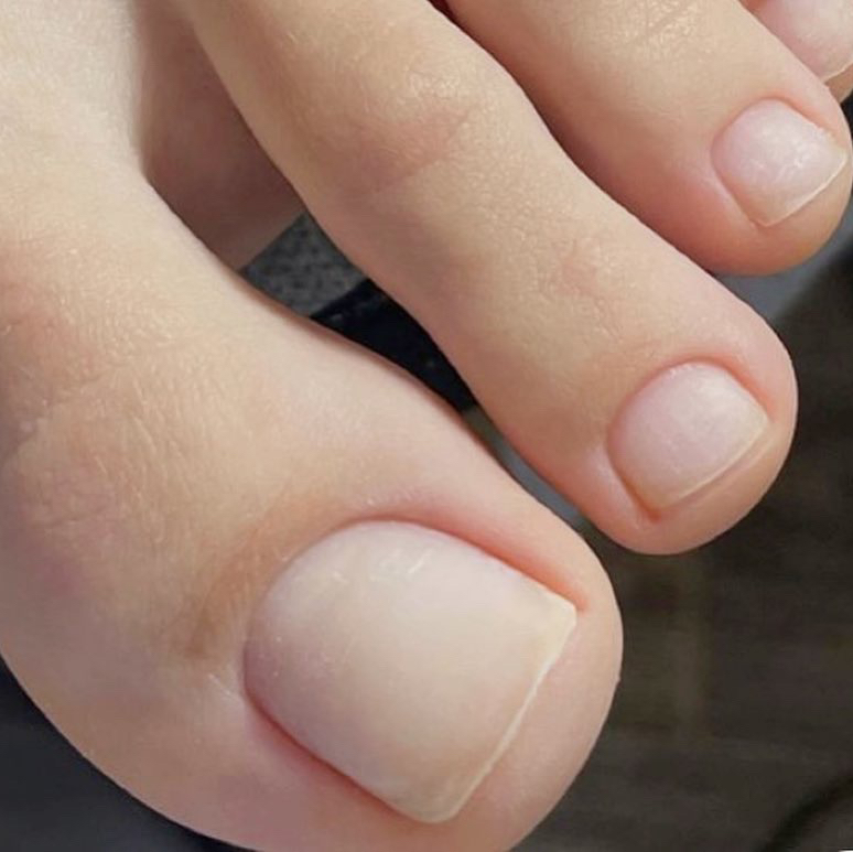 Протезирование ногтей при онихолизисе