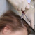 Микронидлинг (волосистой части головы)
