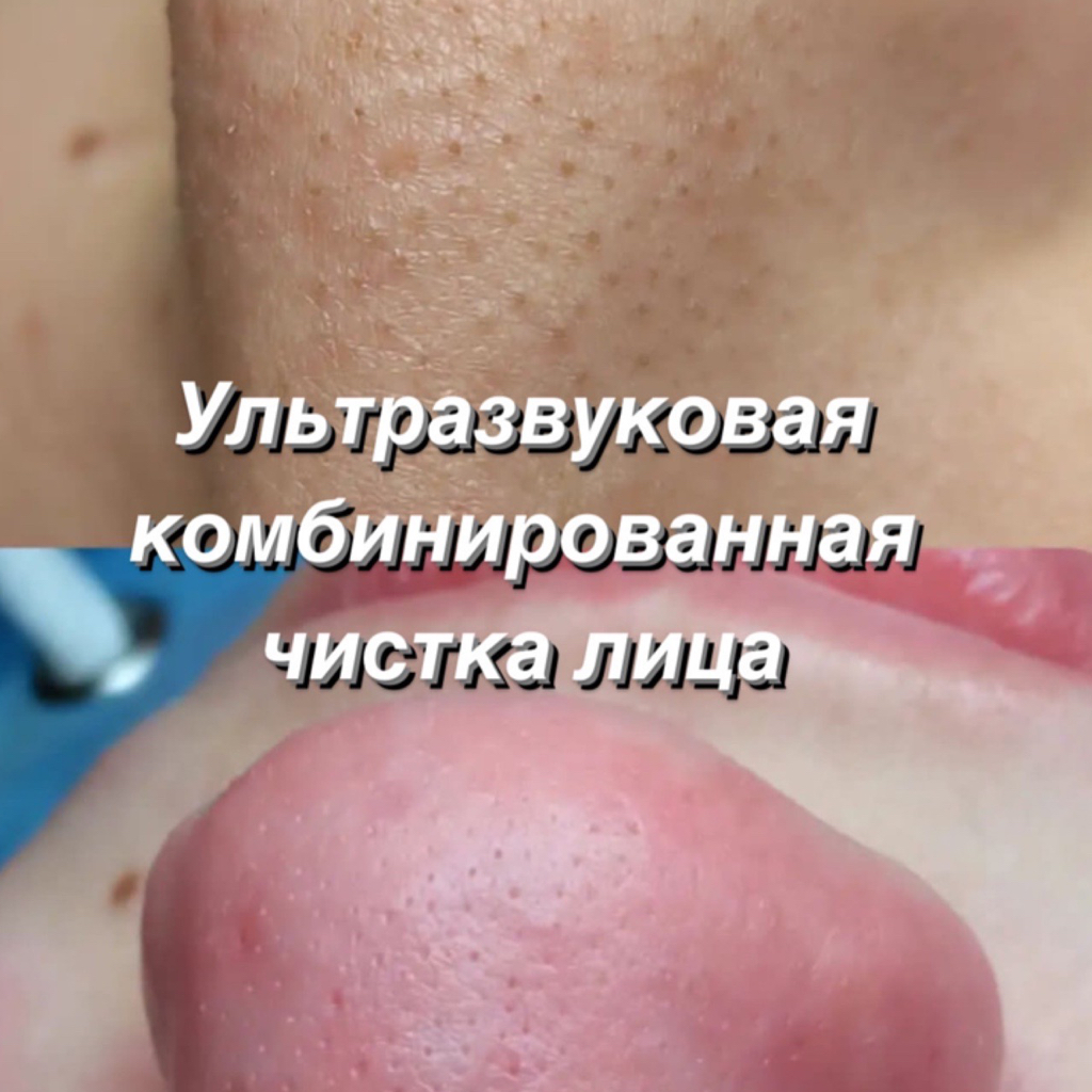 Ультразвуковая комбинированная  чистка лица