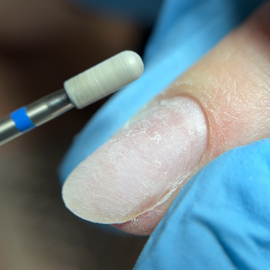 Снятие искусственного материала