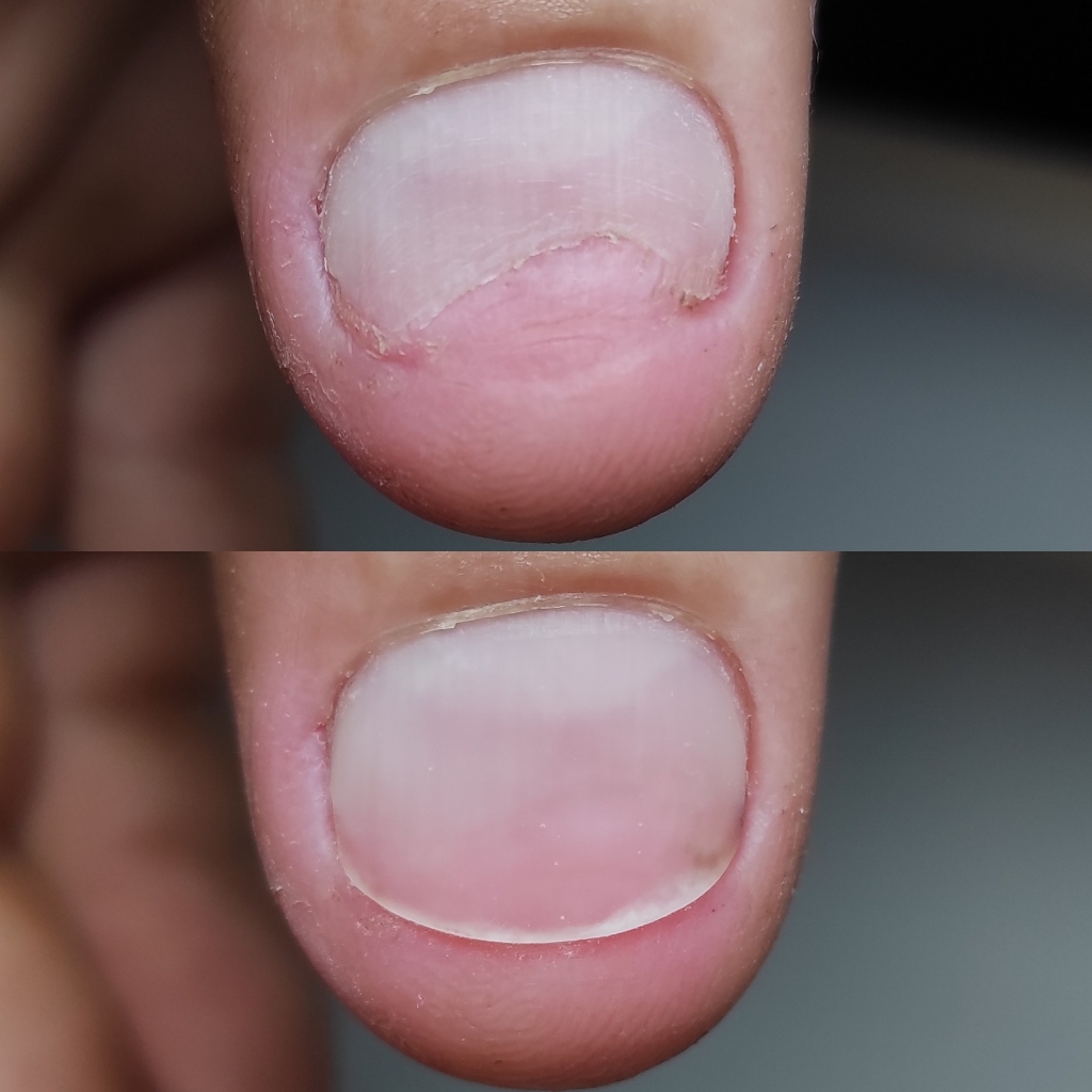 Протезирование ногтевой пластины на руках 1-3 ногтя