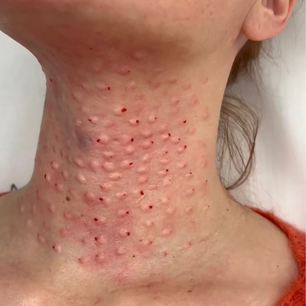 Биоревитализация (Аквашайн) Корея 2мл