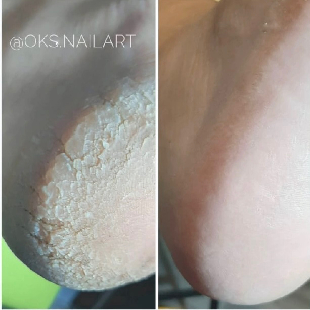 Обработка стоп