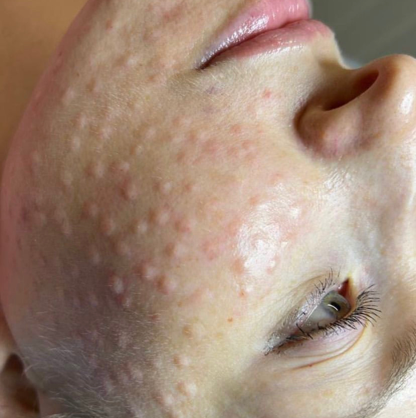 Биоревитализация (Профайло) Италия 2мл