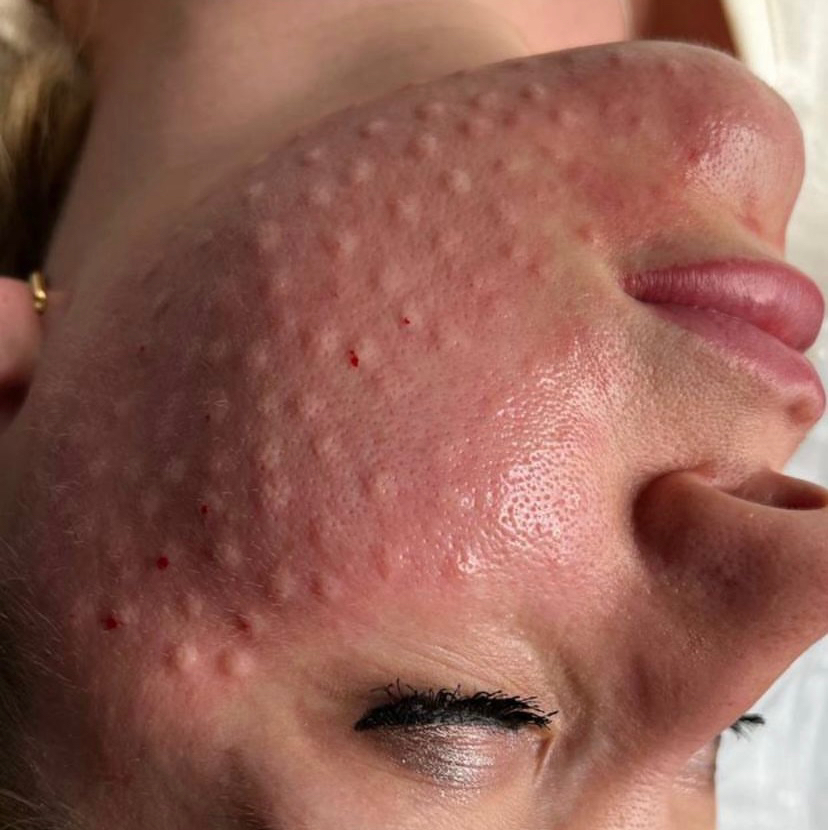 Биоревитализация(Новокутан) Франция 2мл