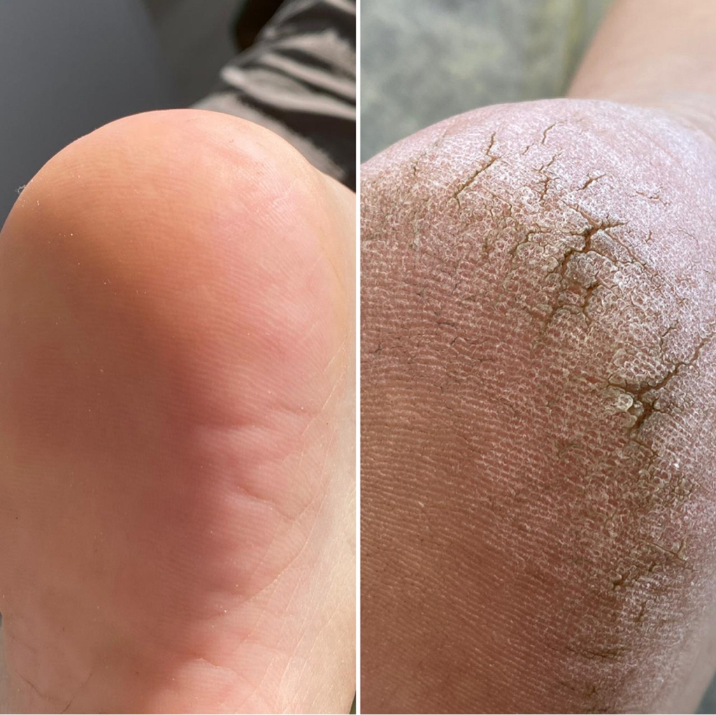 Обработка стоп без покрытия