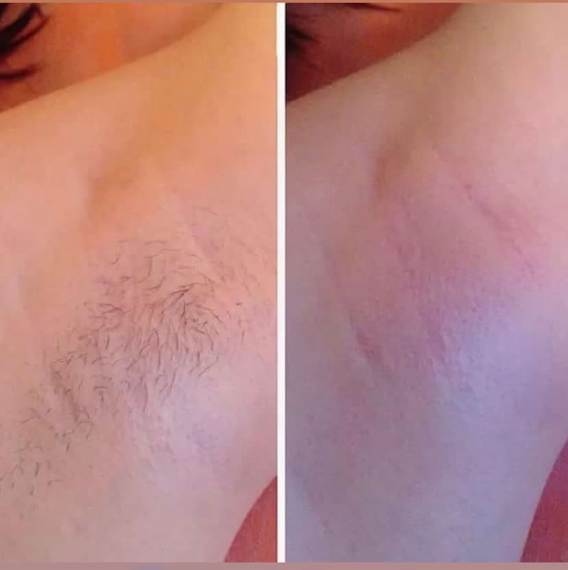 Шугаринг подмышек