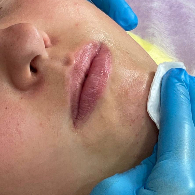 Шугаринг усики, бакенбарды, лоб, подбородок, линия волос -стоимость за одну зону