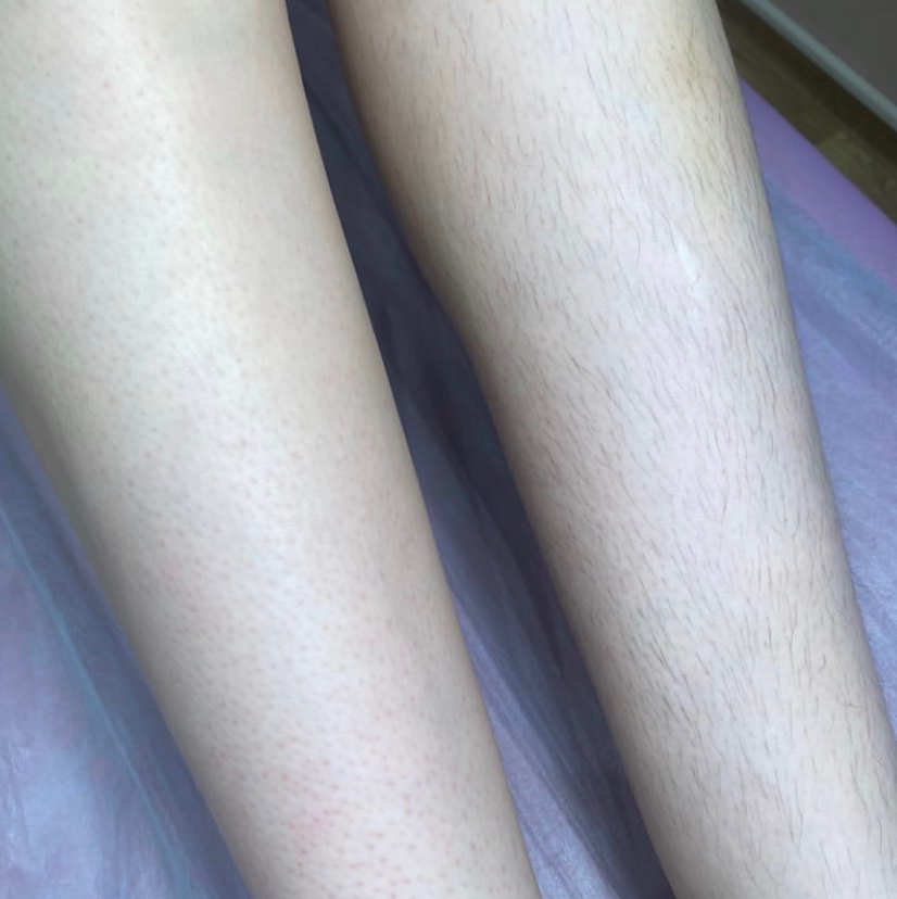 Шугаринг ноги полностью