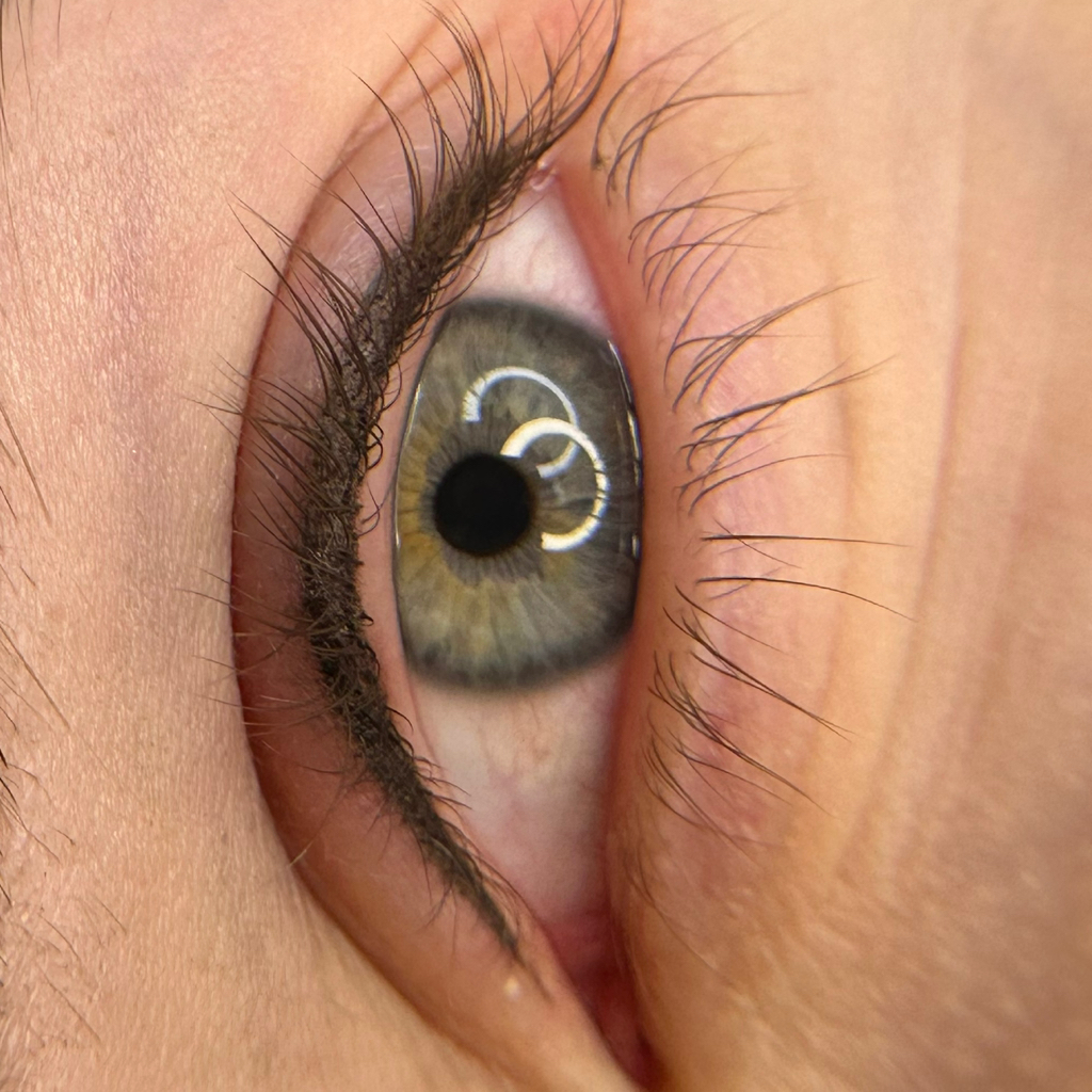 Межресничка