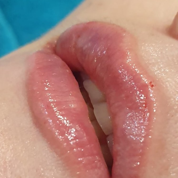 Контурная пластика губ