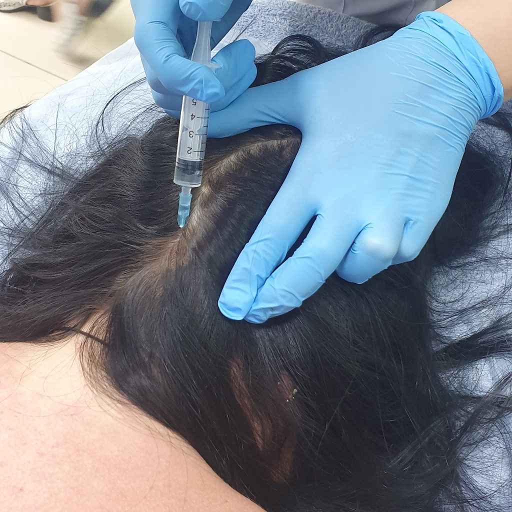 мезотерапия волосистой части головы