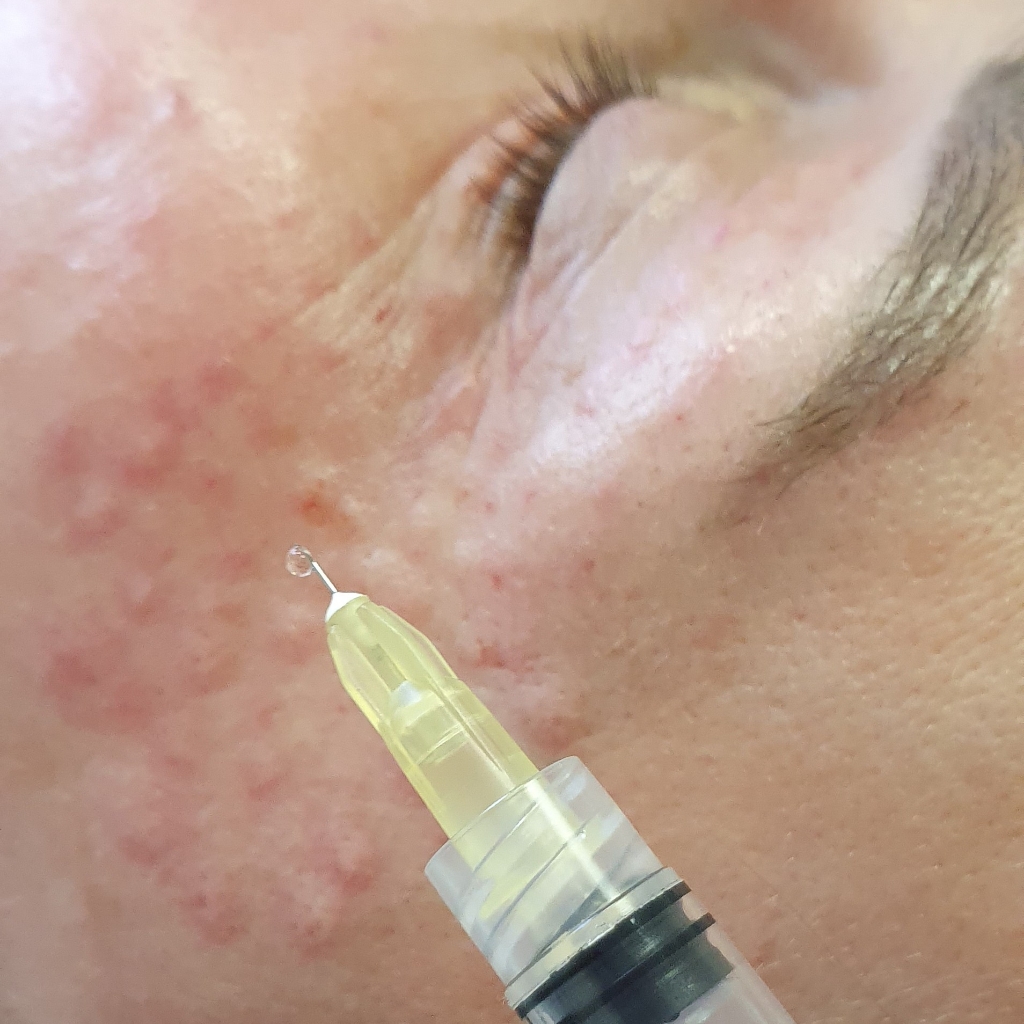 биоревитализация