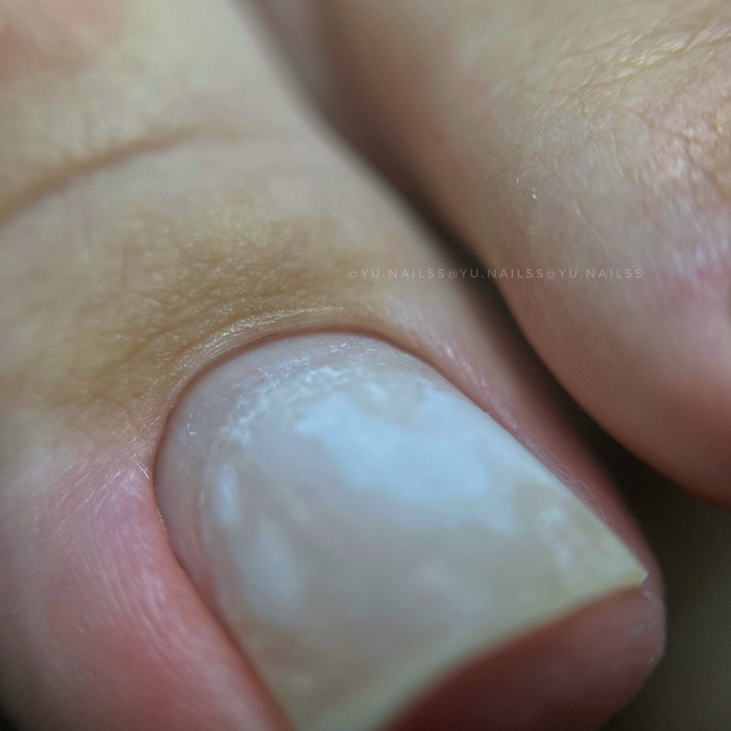 Снятие покрытия на ногах