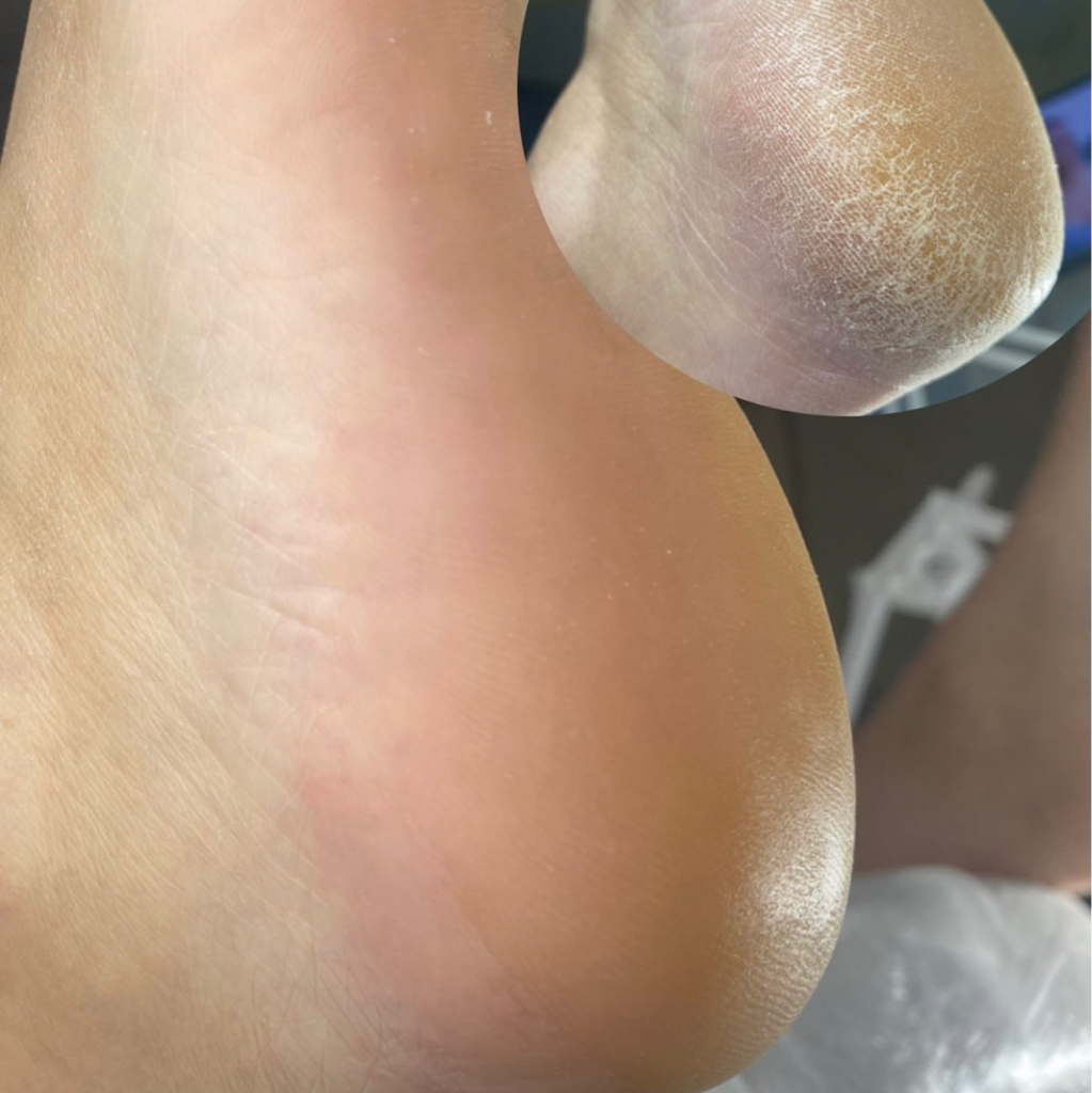 Обработка стоп