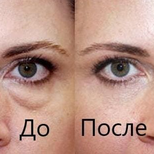 Биоревитализация Blumgel Amber Shine Eyes, 0,5 мл