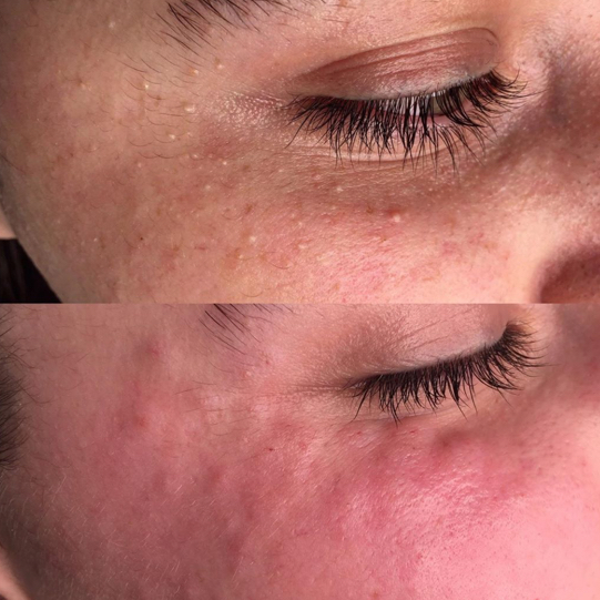 Механическая Чистка лица