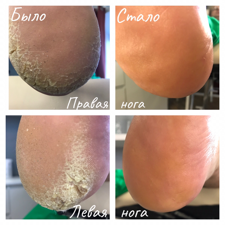 Подологический педикюр: обработка сложных стоп и проблемных ногтей