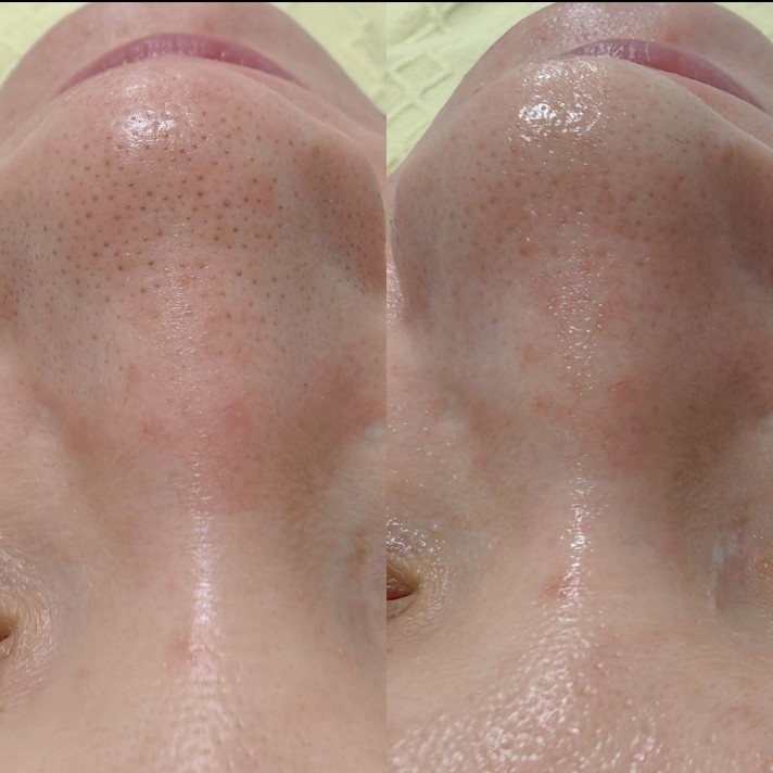 Чистка лица