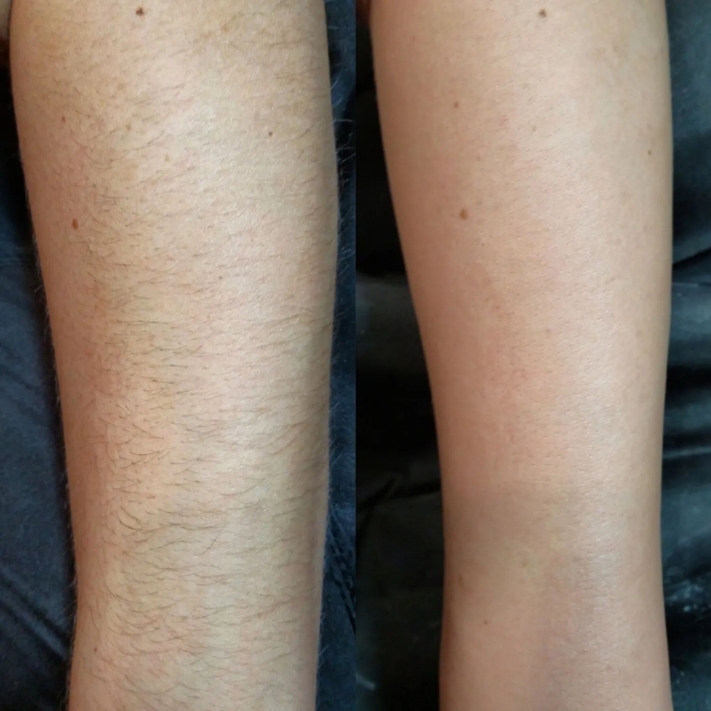 Депиляция: руки полностью.