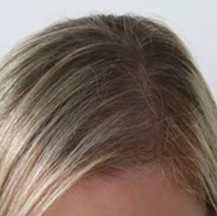 Трихопигментация фронтально-теменные зоны