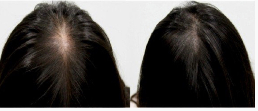 Трихопигментация затылочной зоны