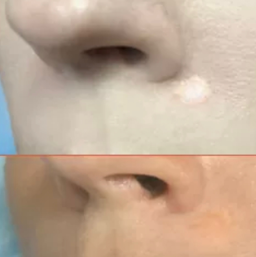 Камуфляж шрама, рубца до 1 см