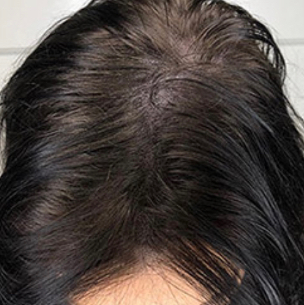 Трихопигментация смешенная техника височные зоны, челка