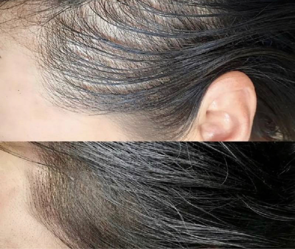 Трихопигментация височной зоны