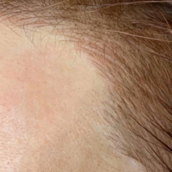 Трихопигментация височные зоны волосковая техника