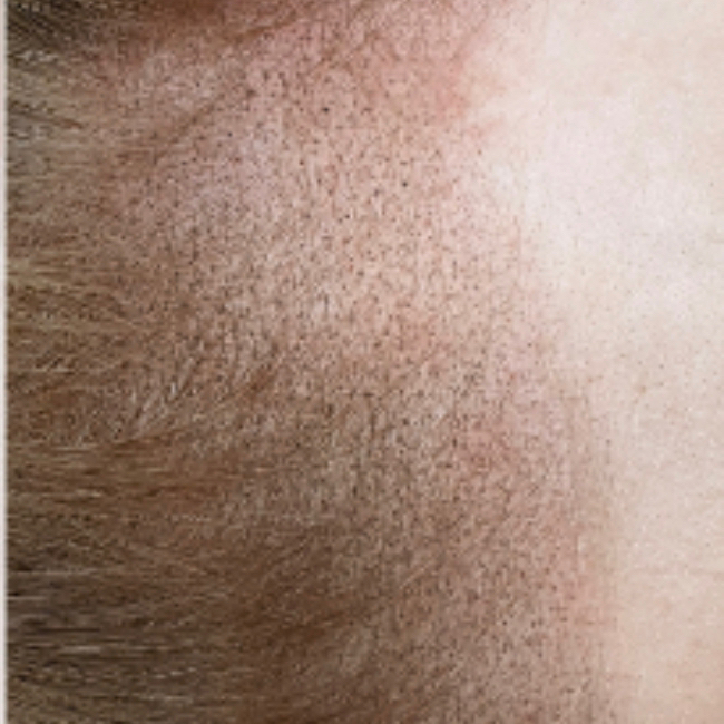 Коррекция трихопигментации