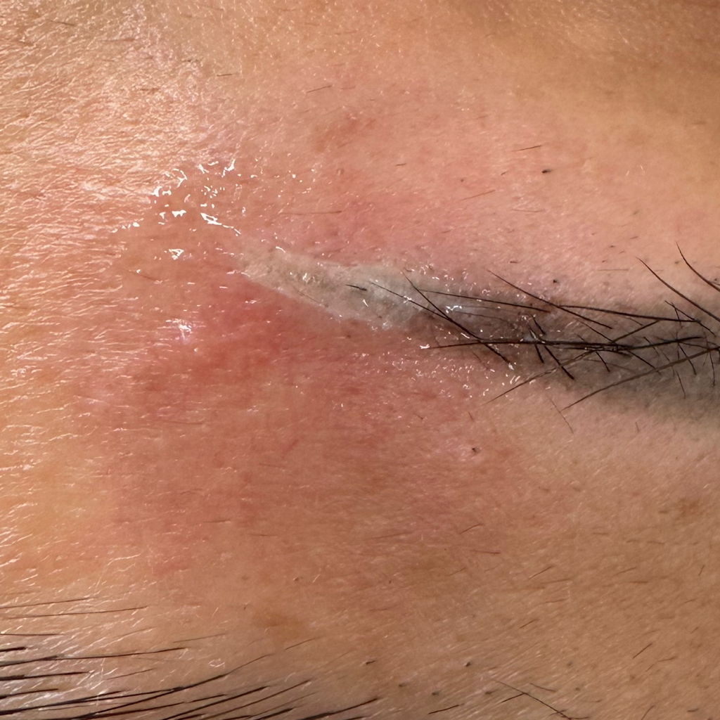 Повторное удаление татуажа REMOVER