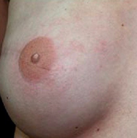 Камуфляж ареолы