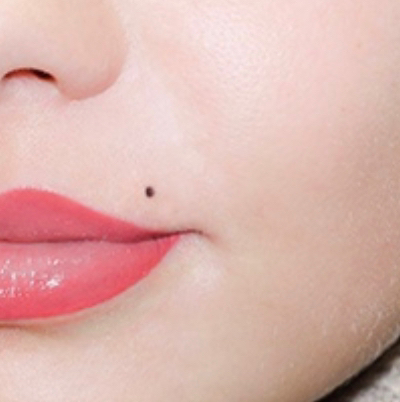 Коррекция мушки над губой