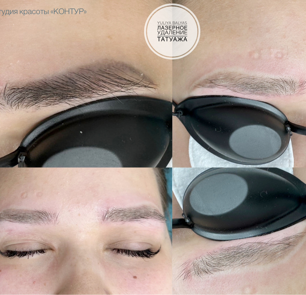 ЛАЗЕРНОЕ УДАЛЕНИЕ татуажа бровей/губ