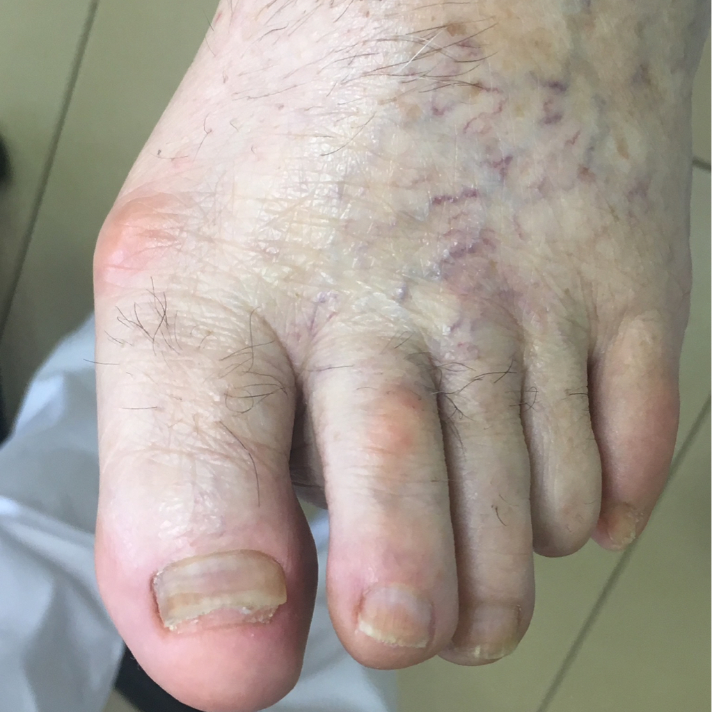 Подологический педикюр