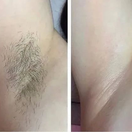 Шугаринг подмышек