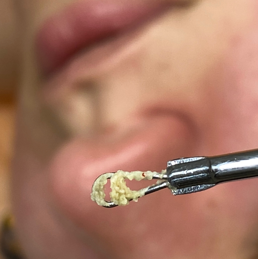 Механическая чистка+пилинг