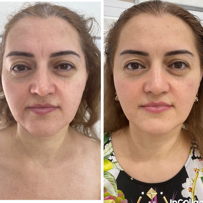 Классический массаж лица