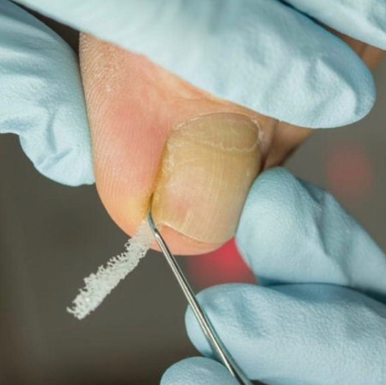 Тампонирование (1 ед)