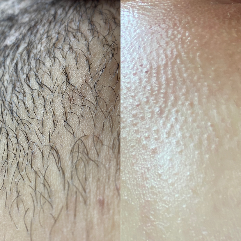 Бикини глубокое