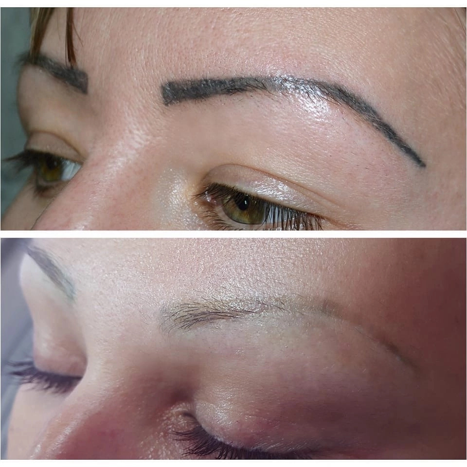 Удаление ремувером