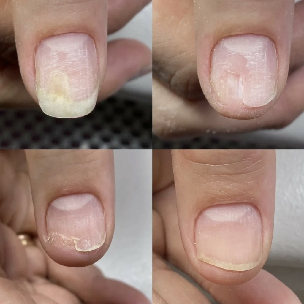 зачищение онихолизиса до 3ёх ногтей