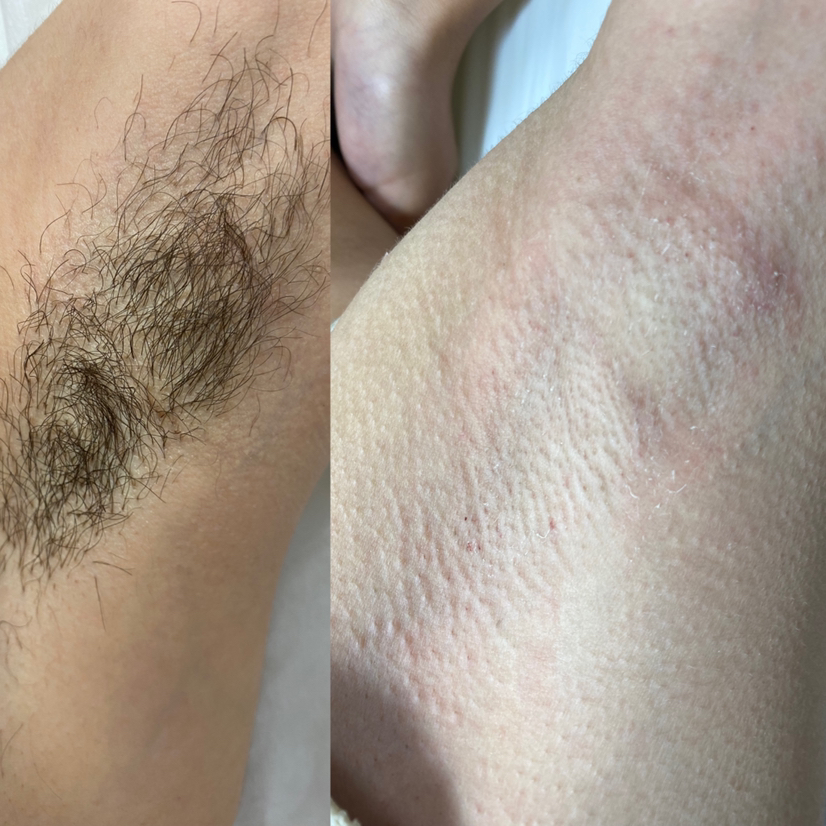 Подмышечные впадины